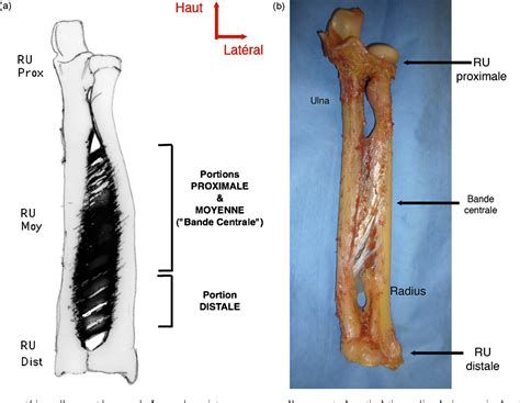 interosseous membrane injury forearm